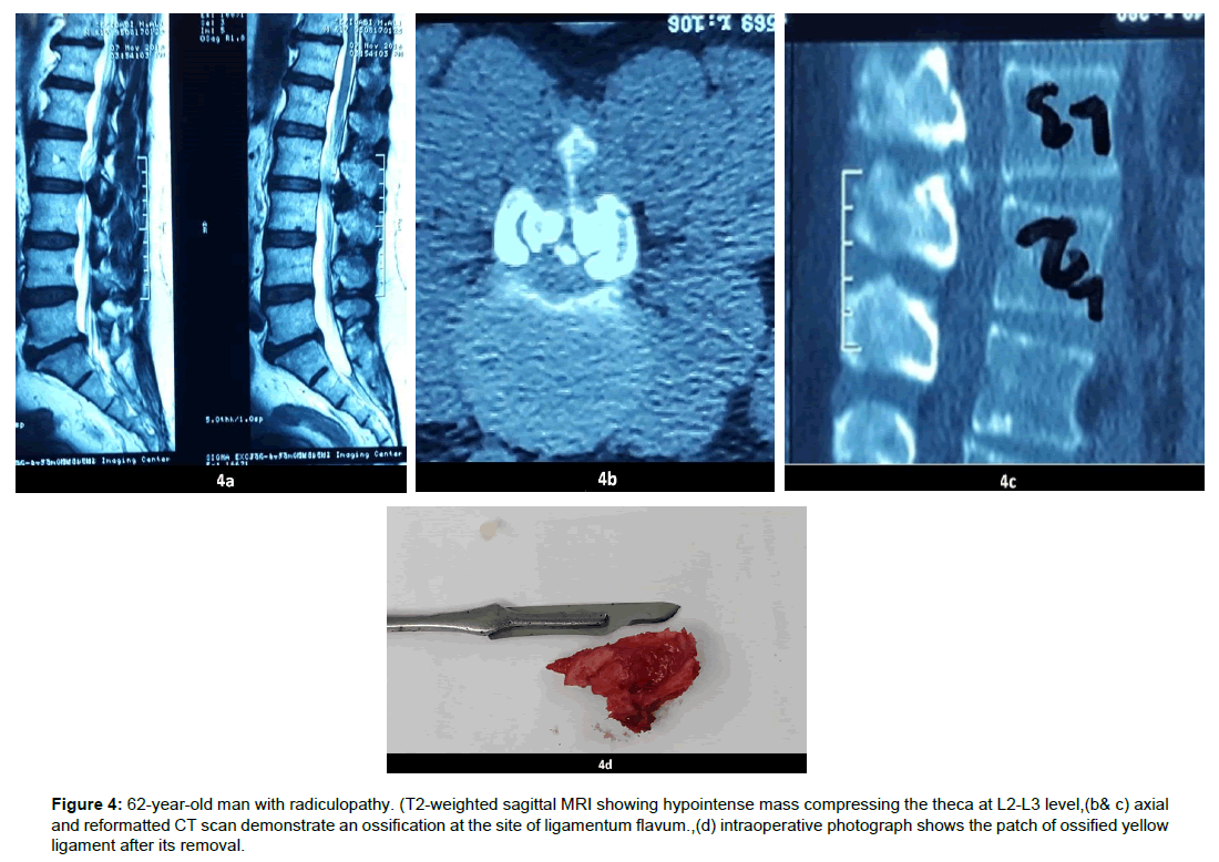 spine-neurosurgery-hypointense-mass