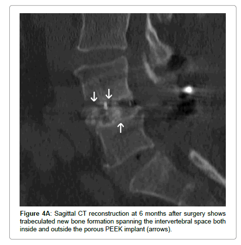 spine-neurosurgery-implant