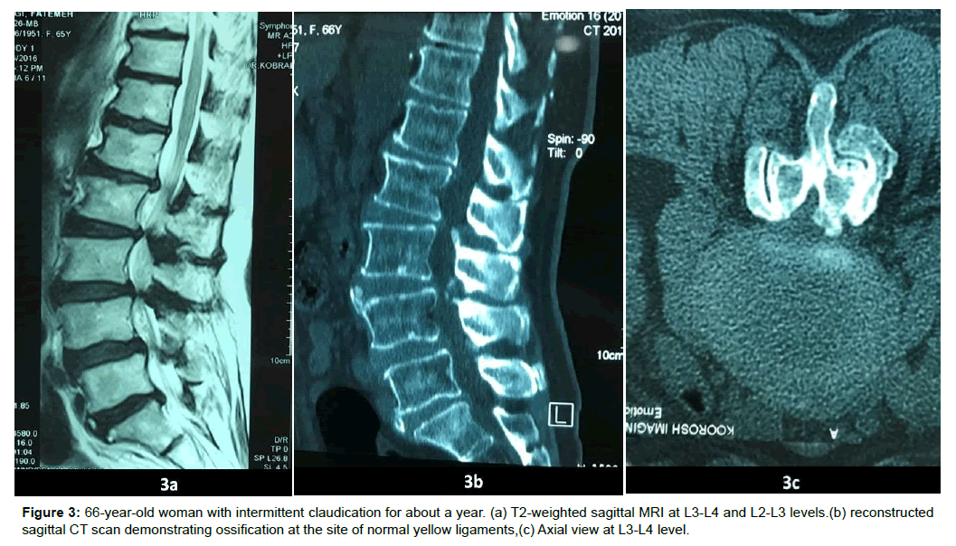 spine-neurosurgery-intermittent-claudication