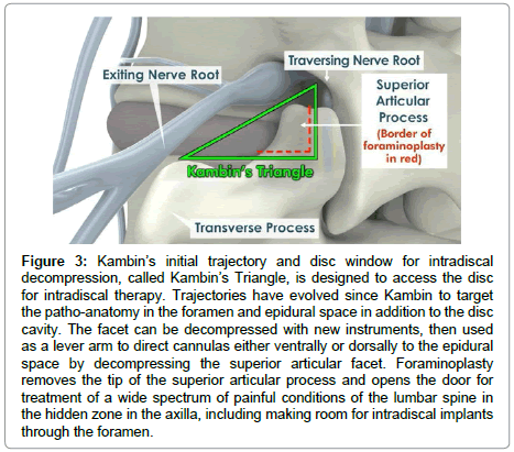 spine-neurosurgery-intradiscal-therapy