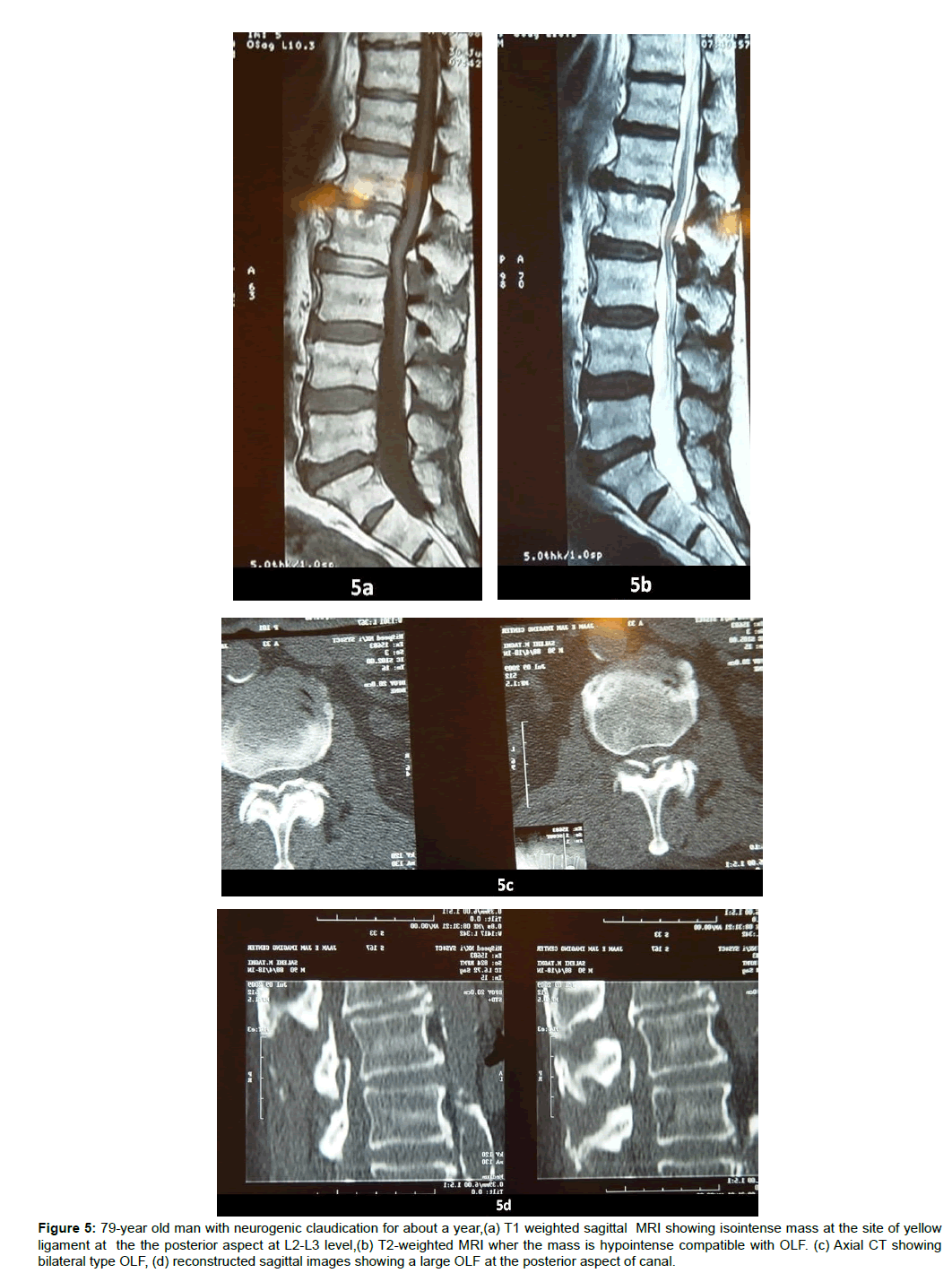 spine-neurosurgery-isointense-mass