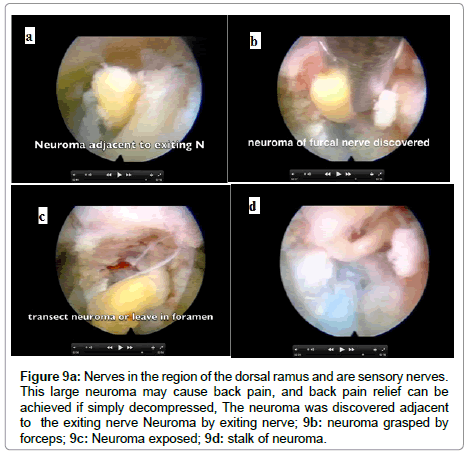 spine-neurosurgery-large-neuroma