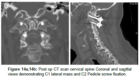 spine-neurosurgery-lateral-mass