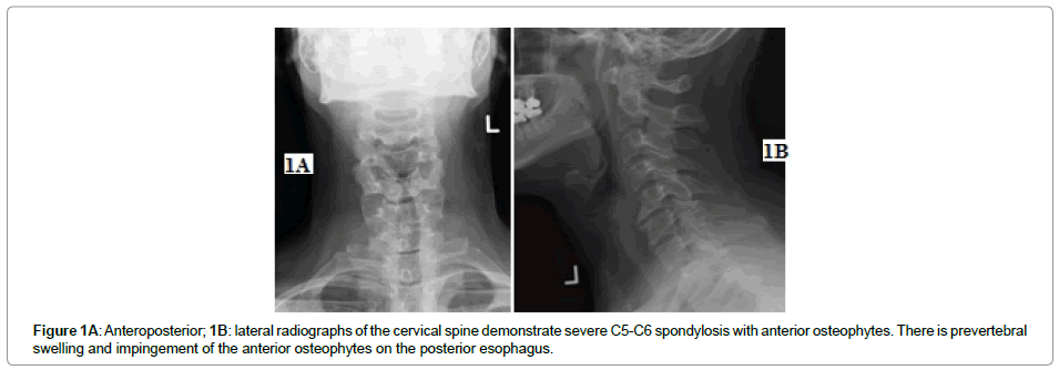 Anterior Osteophytes Cervical Spine