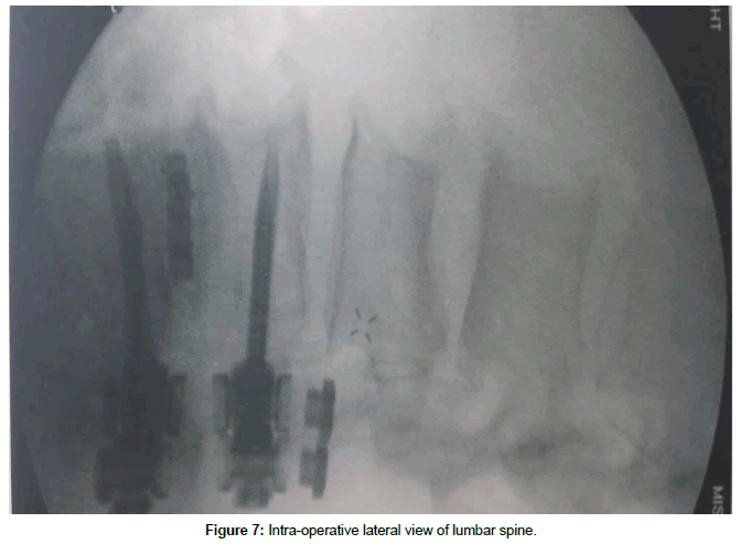 spine-neurosurgery-lateral-view