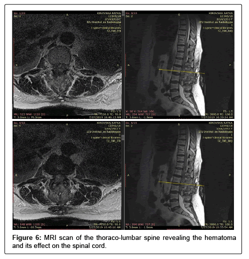 spine-neurosurgery-lumbar spine-neurosurgery-lumbar