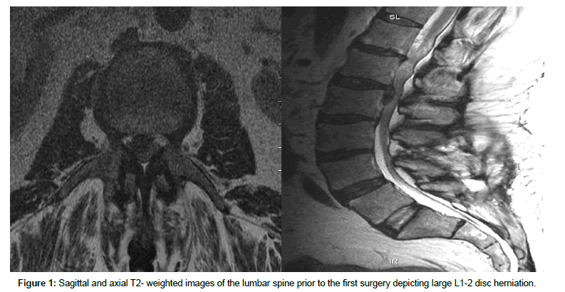 spine-neurosurgery-lumbar-spine