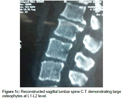 spine-neurosurgery-lumbar-spine