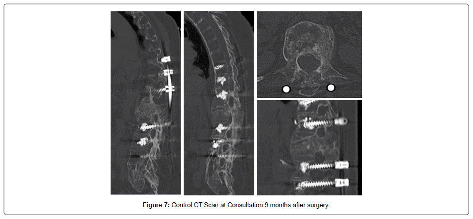 spine-neurosurgery-months-surgery