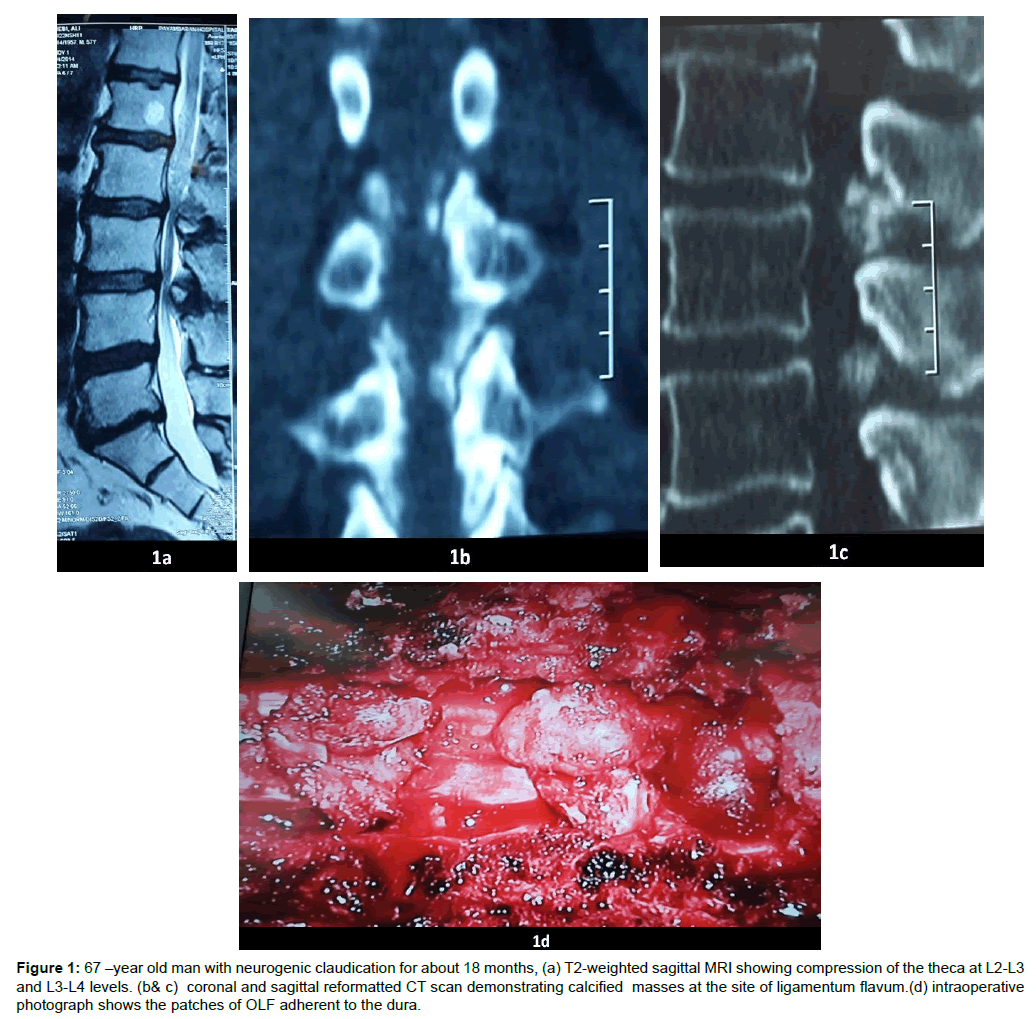 spine-neurosurgery-neurogenic-claudication