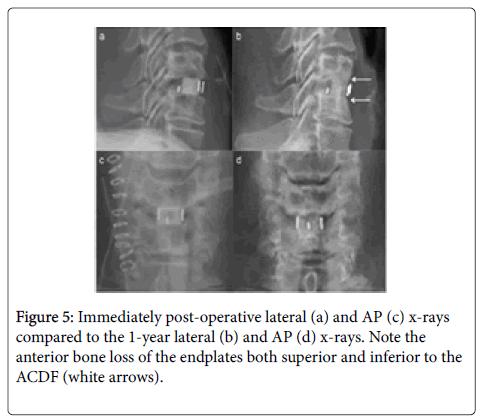 spine-neurosurgery-operative-lateral