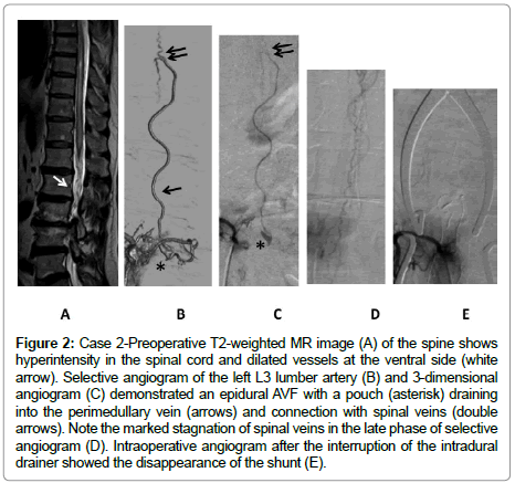 spine-neurosurgery-perimedullary-vein