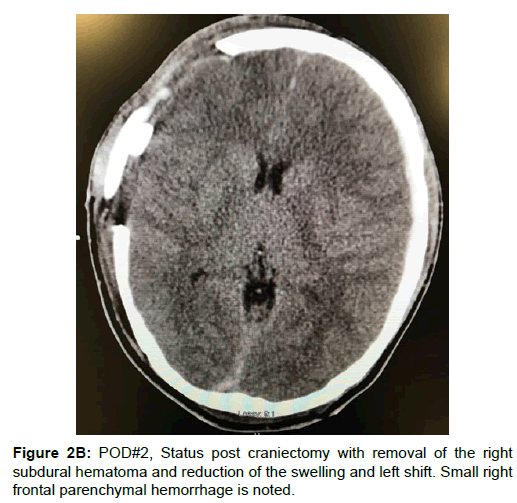 spine-neurosurgery-post-craniectomyl