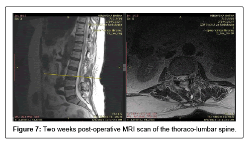 spine-neurosurgery-post-operative spine-neurosurgery-post-operative