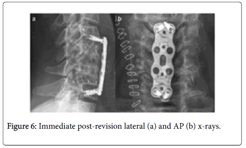 spine-neurosurgery-post-revision