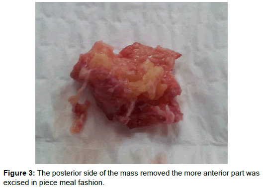 spine-neurosurgery-posterior-side