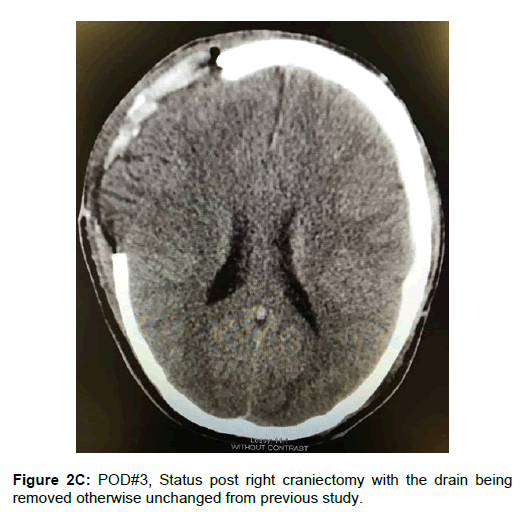spine-neurosurgery-right-craniectomy