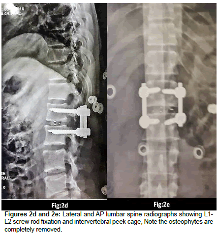 spine-neurosurgery-rod-fixation