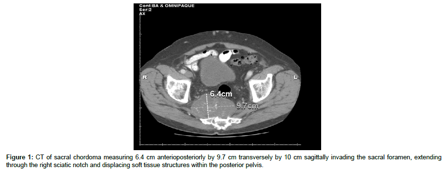 spine-neurosurgery-sacral-chordoma