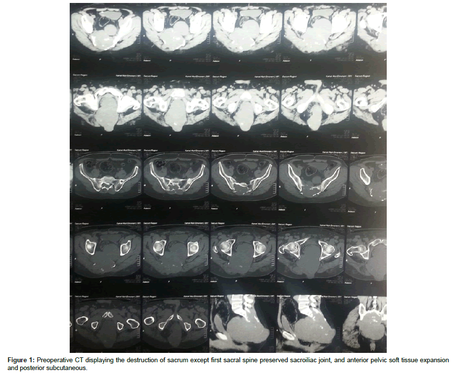 spine-neurosurgery-sacral-spine