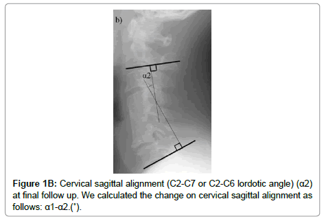spine-neurosurgery-sagittal-alignment