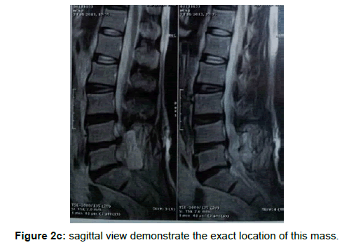 spine-neurosurgery-sagittal-demonstrate