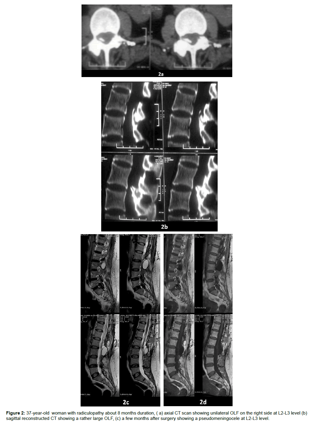 spine-neurosurgery-sagittal-reconstructed