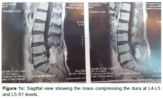spine-neurosurgery-sagittal-view
