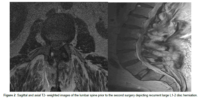 spine-neurosurgery-second-surgery