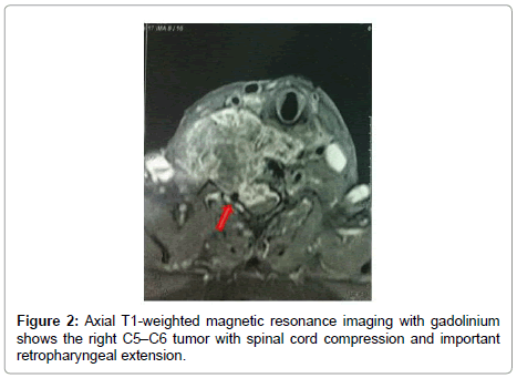 spine-neurosurgery-spinal-cord