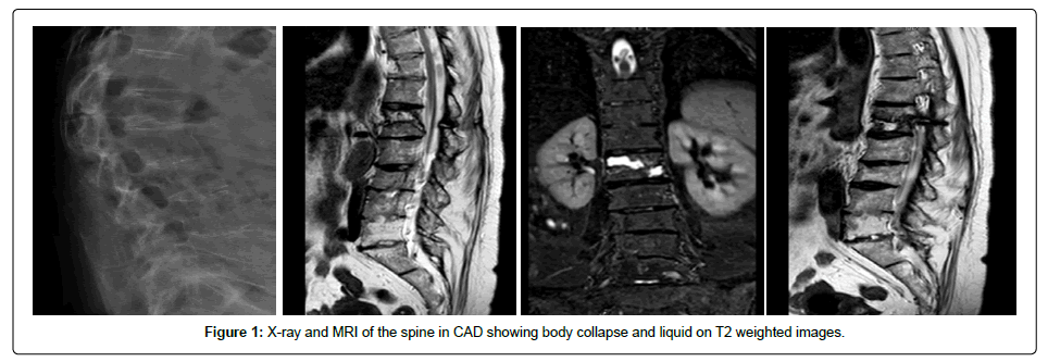 spine-neurosurgery-spine-CAD