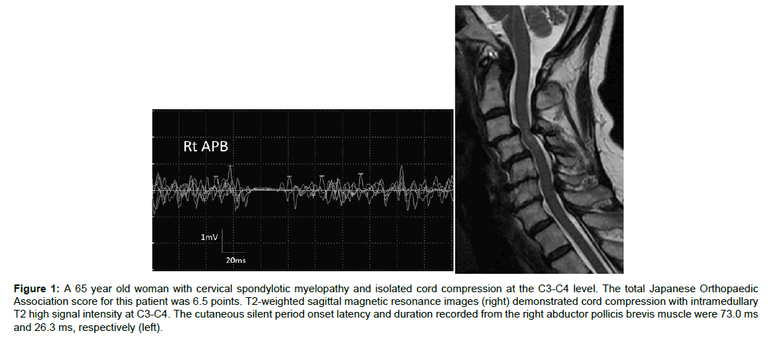 spine-neurosurgery-spondylotic-myelopathy