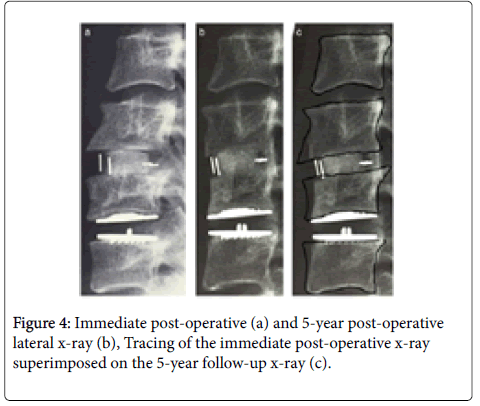 spine-neurosurgery-superimposed