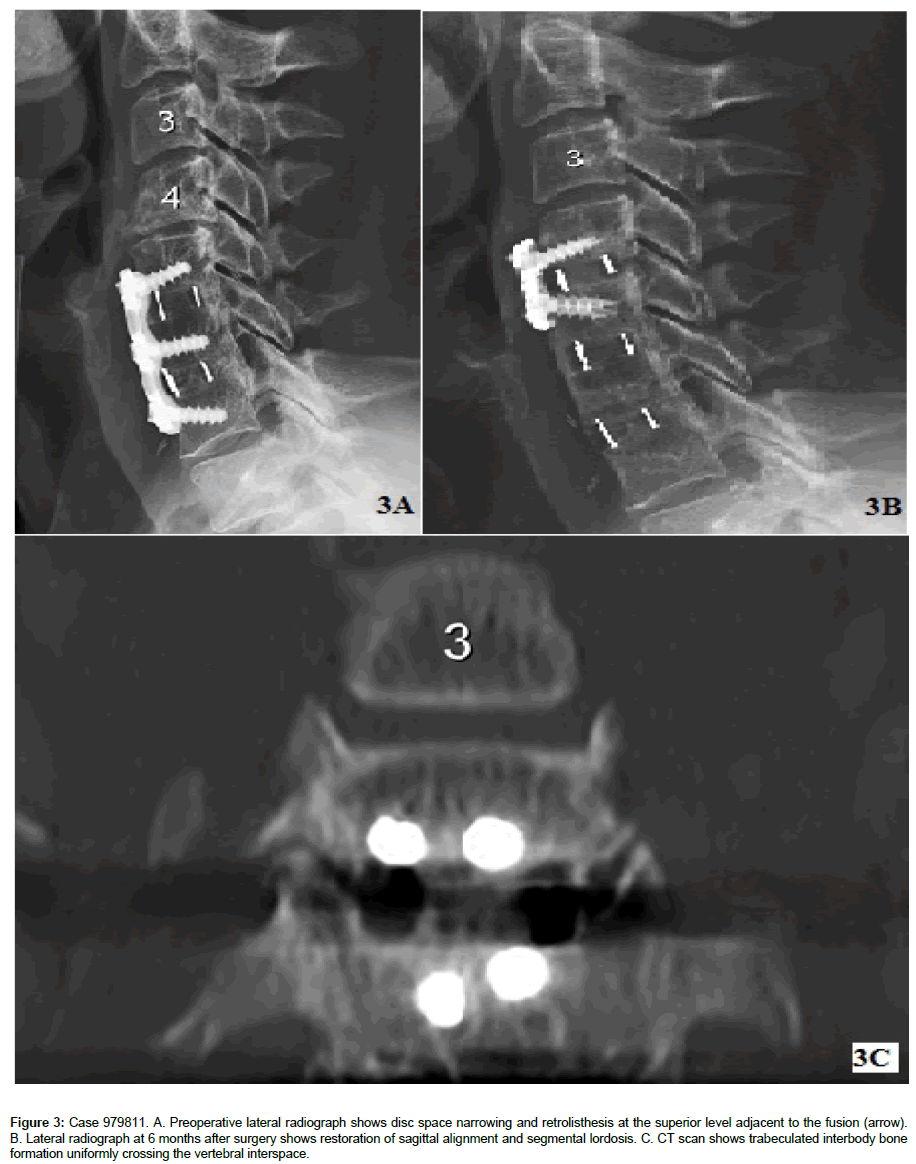 spine-neurosurgery-superior-level