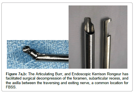 spine-neurosurgery-surgical-decompression