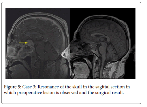 spine-neurosurgery-surgical-result