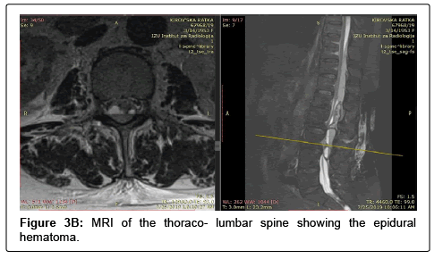 spine-neurosurgery-thoraco