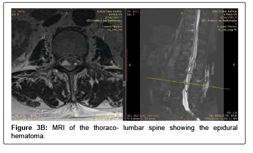 spine-neurosurgery-thoraco spine-neurosurgery-thoraco