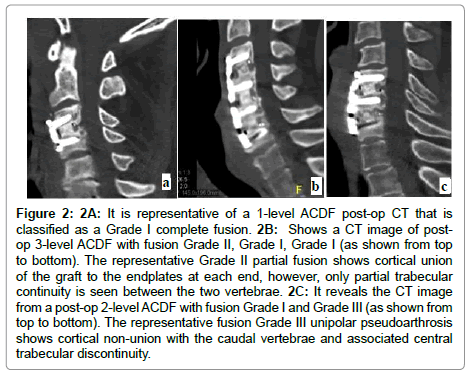 spine-neurosurgery-trabecular-discontinuity