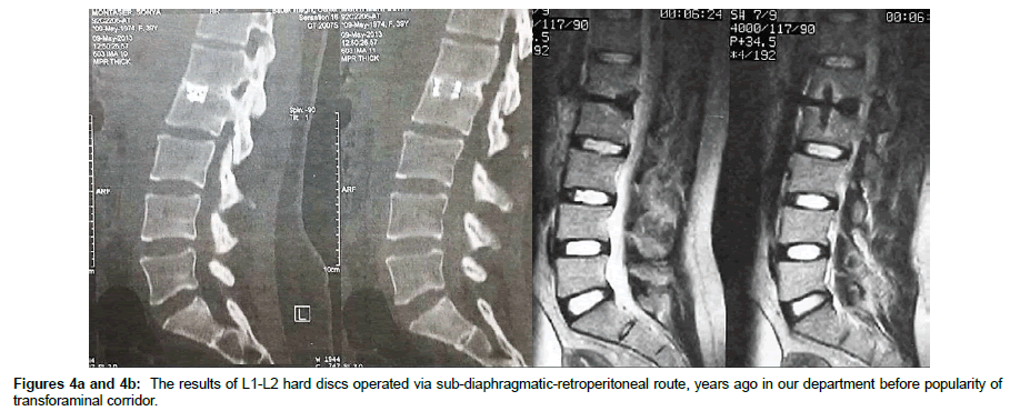 spine-neurosurgery-transforaminal-corridor