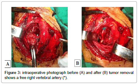 spine-neurosurgery-tumor-removal