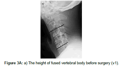 spine-neurosurgery-vertebral-body