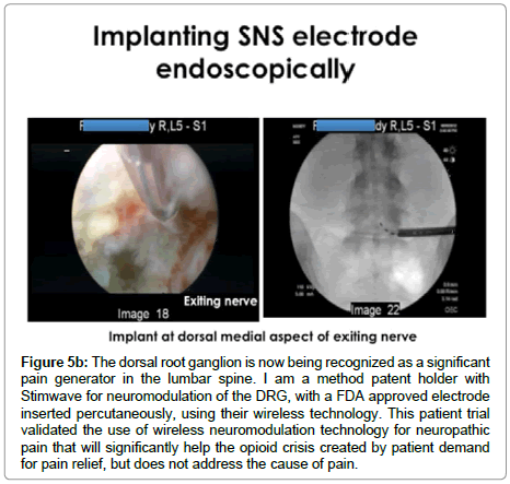 spine-neurosurgery-wireless-neuromodulation
