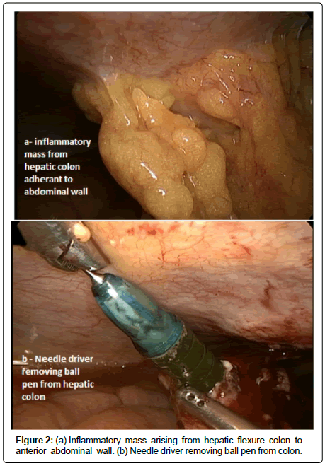 surgery-clinical-practice-Inflammatory-mass