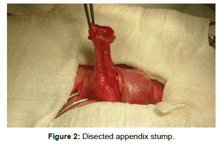 surgery-clinical-practice-disected-appendix-stump