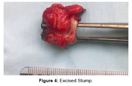surgery-clinical-practice-excised-stump