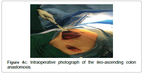 surgery-clinical-practice-ileo-ascending