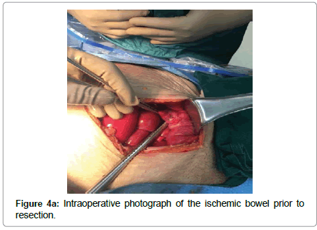 surgery-clinical-practice-ischemic-bowel