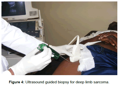 surgery-clinical-practice-limb-sarcoma