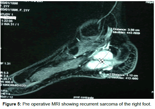 surgery-clinical-practice-recurrent-sarcoma